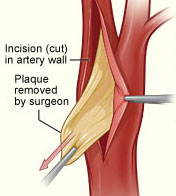 Image of Carotid Paque being removed