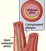 Image of result of stenting